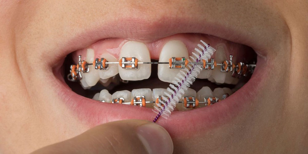 بهداشت و تمیز کردن ارتودنسی فلزی ثابت با مسواک بین دندانی