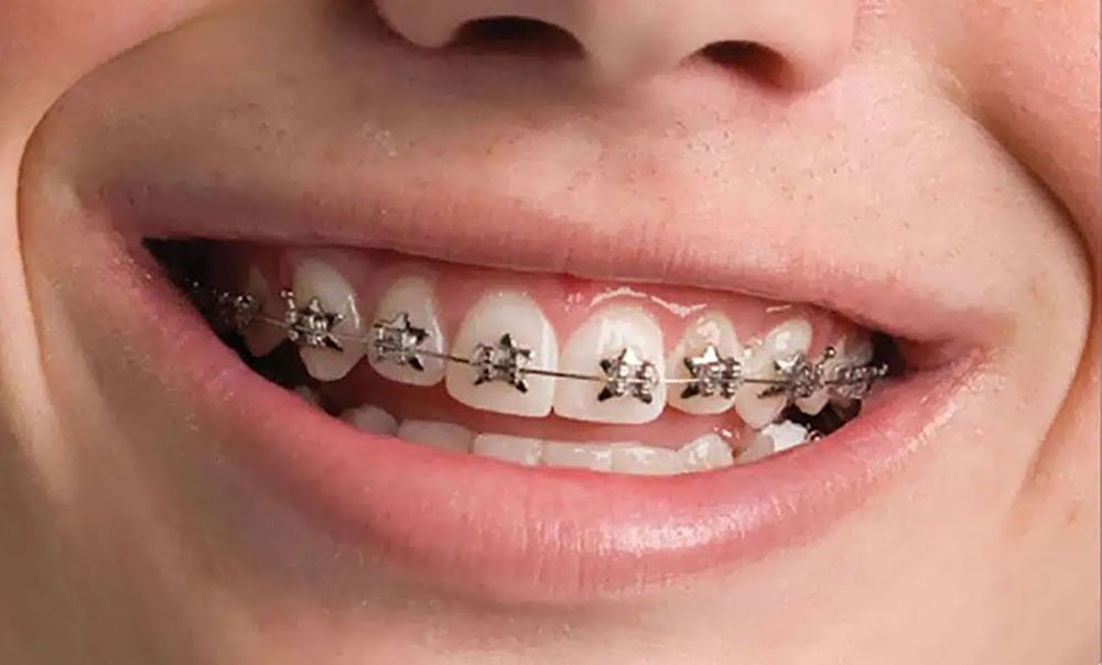 دندان های جلو با ارتودنسی فلزی و براکت های ستاره ای