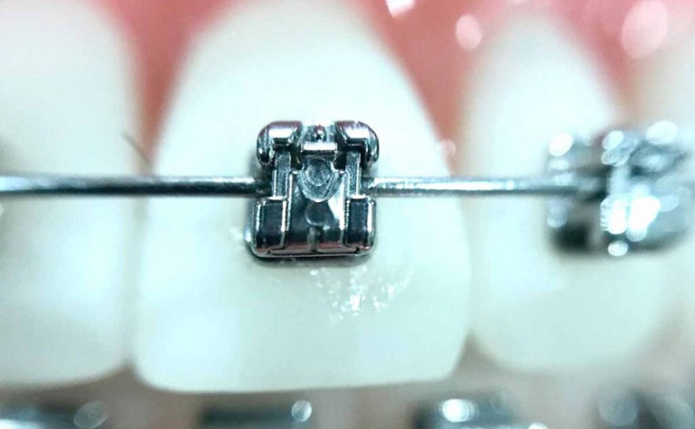 براکت فلزی ارتودنسی ثابت بر روی دندان های جلو