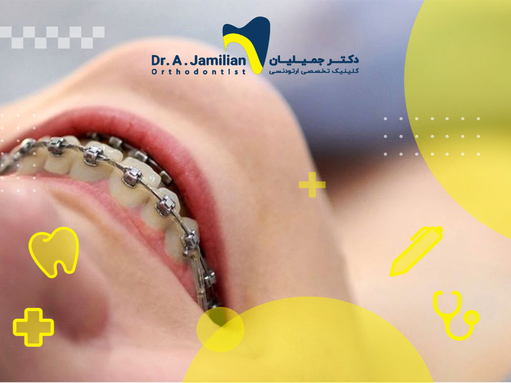 ارتودنسی فلزی، از مزایا و معایب تا قیمت