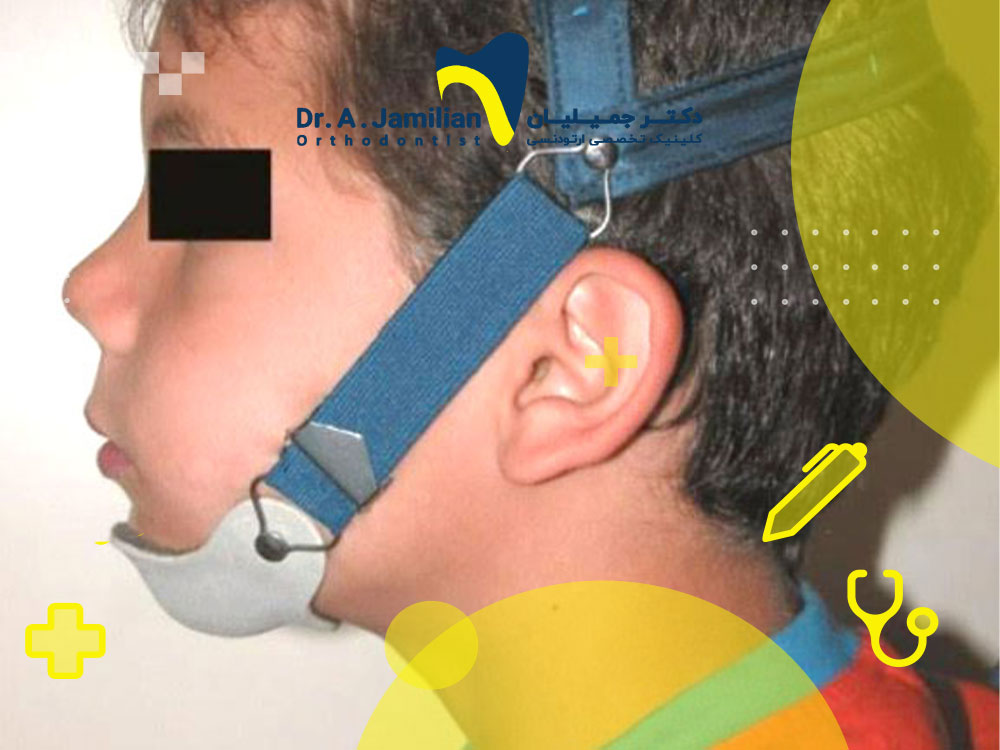 چانه بند طبی یا چانه بند ارتودنسی یا چین کپ بر روی صورت کودک