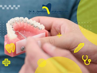 بررسی ارتودنسی لینگوال برای مقایسه با ارتودنسی فلزی کلاسیک