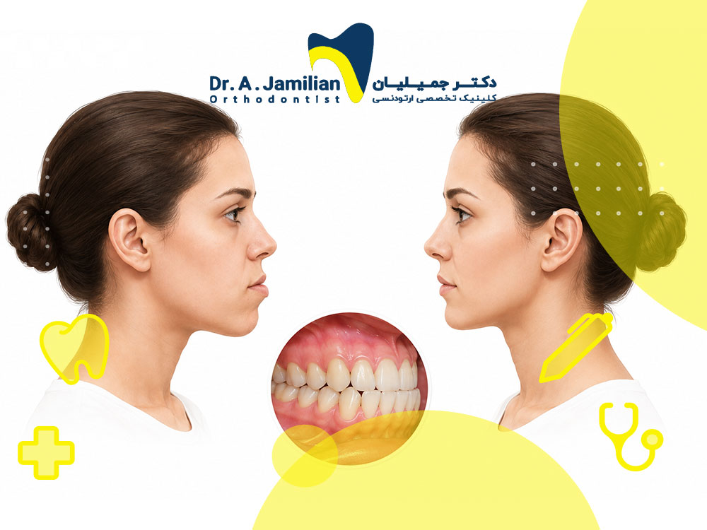 آندربایت دندان چیست؟ علل، عوارض و روشهای درمان جلو بودن فک پایین