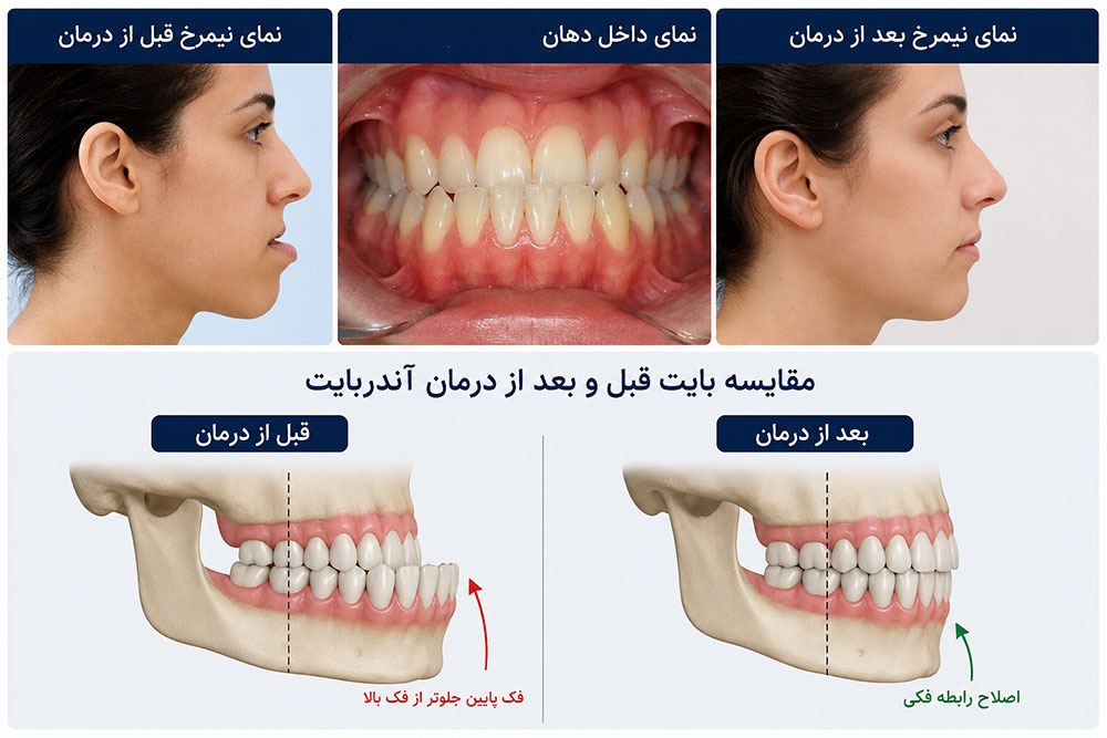 قبل و بعد درمان ارتودنسی آندربایت دندان در نماهای مختلف دندانی و اسکلتی