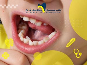 دندان اضافه در لثه کودکان چیست؟ علت و شناسایی علائم